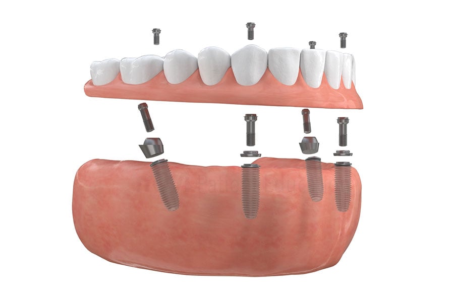 Dental Implants in Plainfield, IL