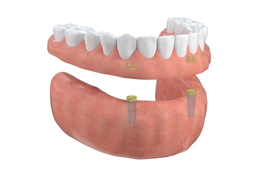 Overdenture Implants in Plainfield, IL