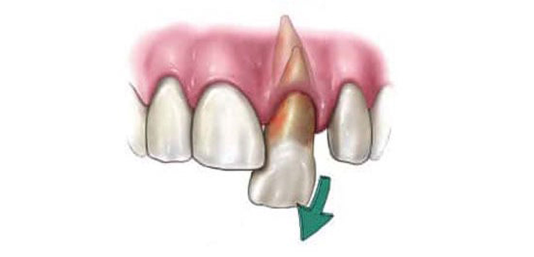 Plainfield, IL Knocked Out Tooth