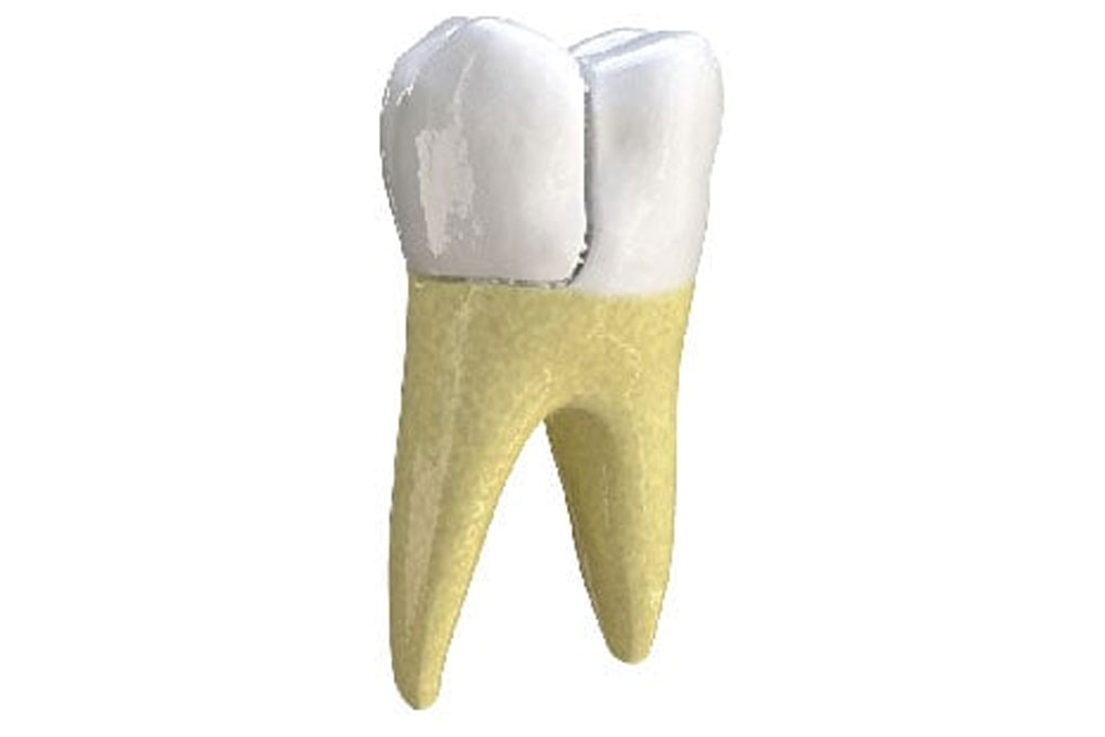 Chipped Tooth in Plainfield, IL