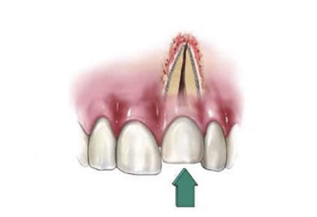 Tooth Extraction in Plainfield, IL