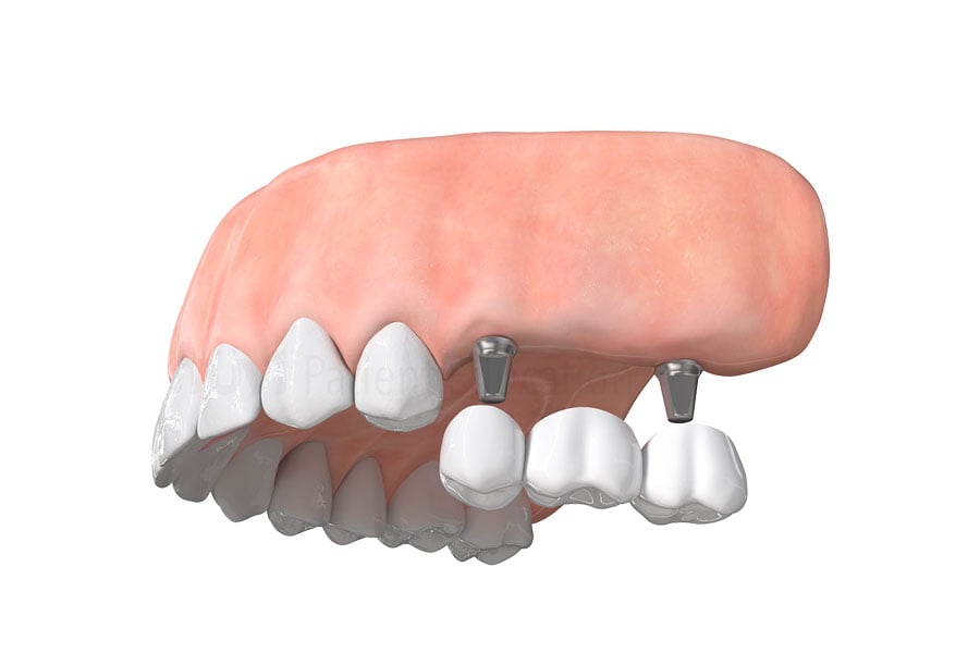 New Dental Implants near Plainfield, IL