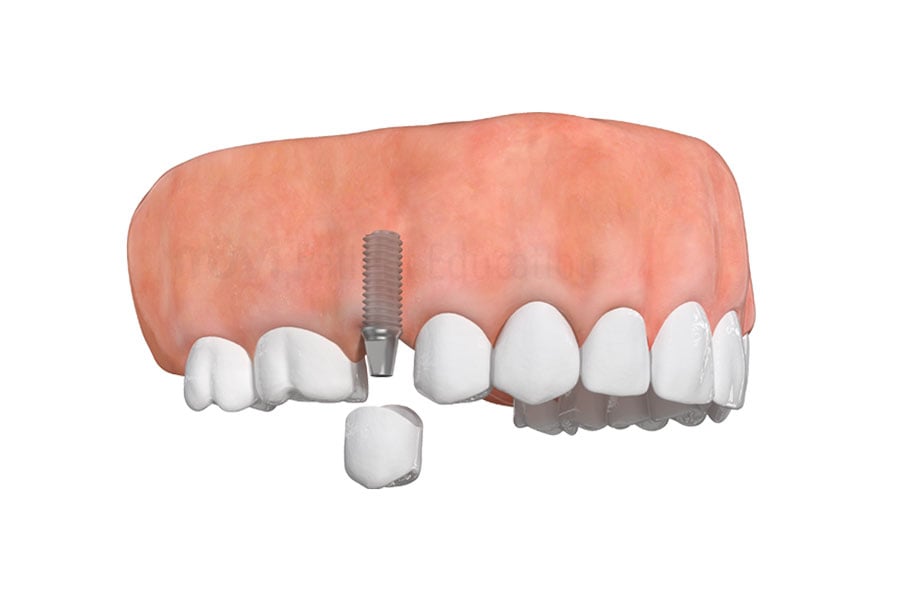 Single Dental Implant Services by Dr. Donald Flynn in Plainfield, IL